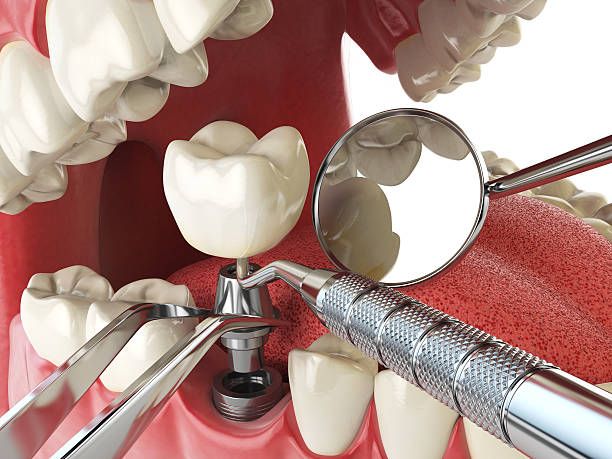 Best Emergency Dental Care for Broken or Chipped Teeth in Wtmore Village, HI